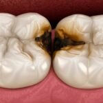 All About Cavities