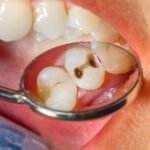 5 Surprising Facts About Cavities You Should Know!