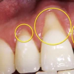 Why Does My Tooth Hurt Suddenly? Common Causes Explained